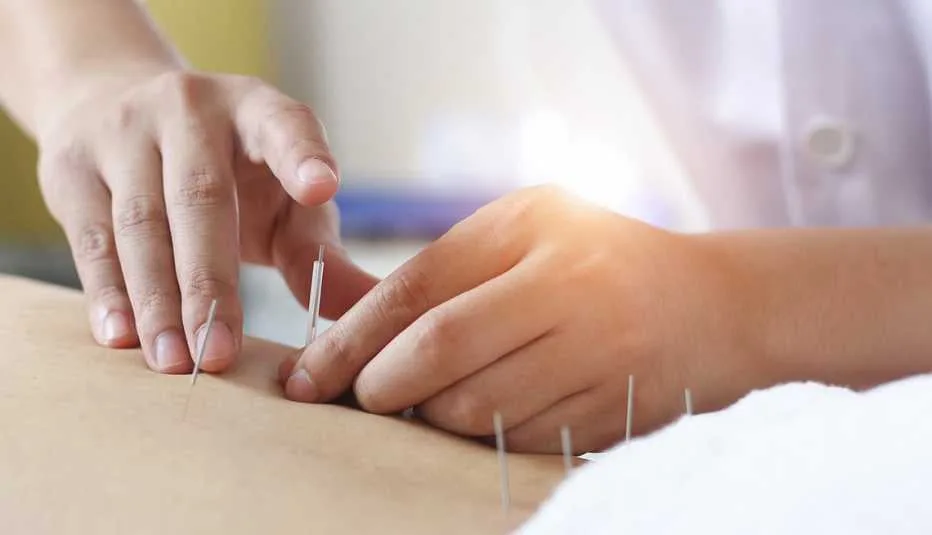 A patient receiving acupuncture treatment for low back pain