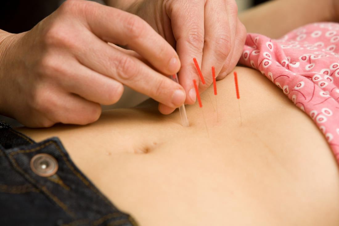 Acupuncture treatment for women's health at PremierMD