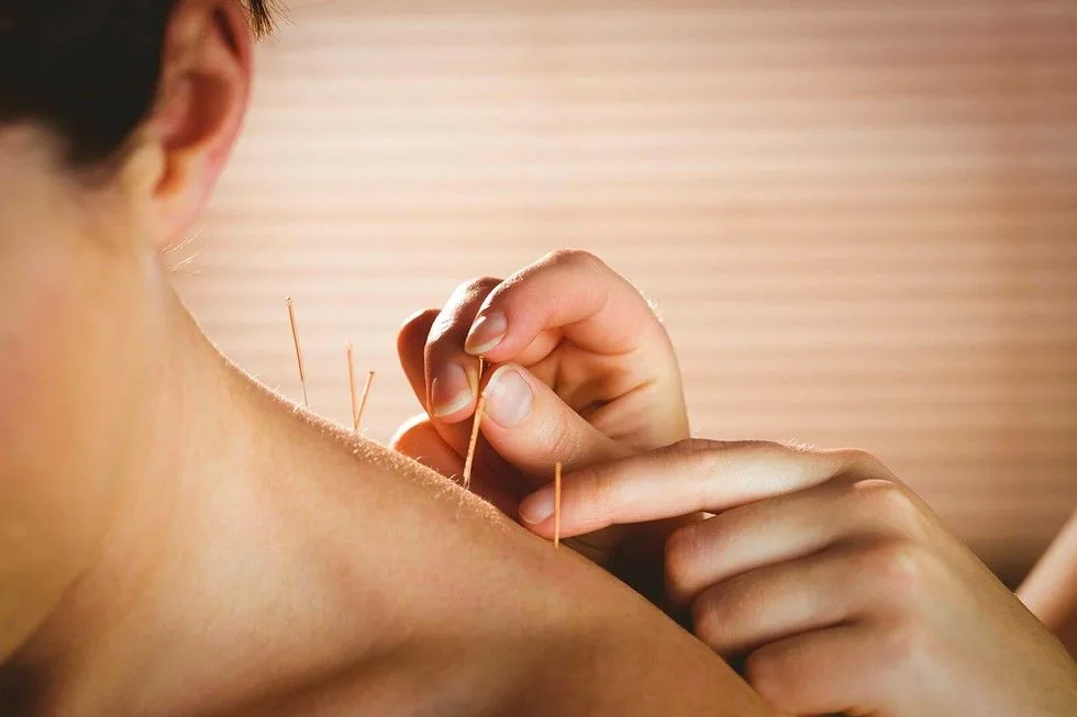 Close view of fine acupuncture needles being placed into a patient's shoulder and upper trapezius