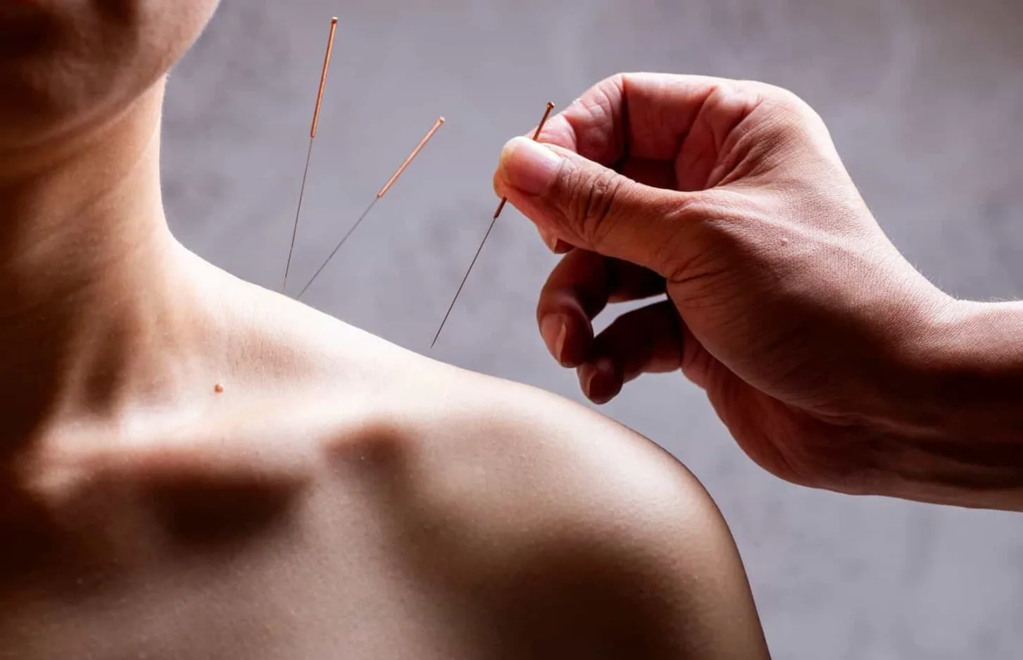 Acupuncture needles being placed in a patient's shoulder for pain relief