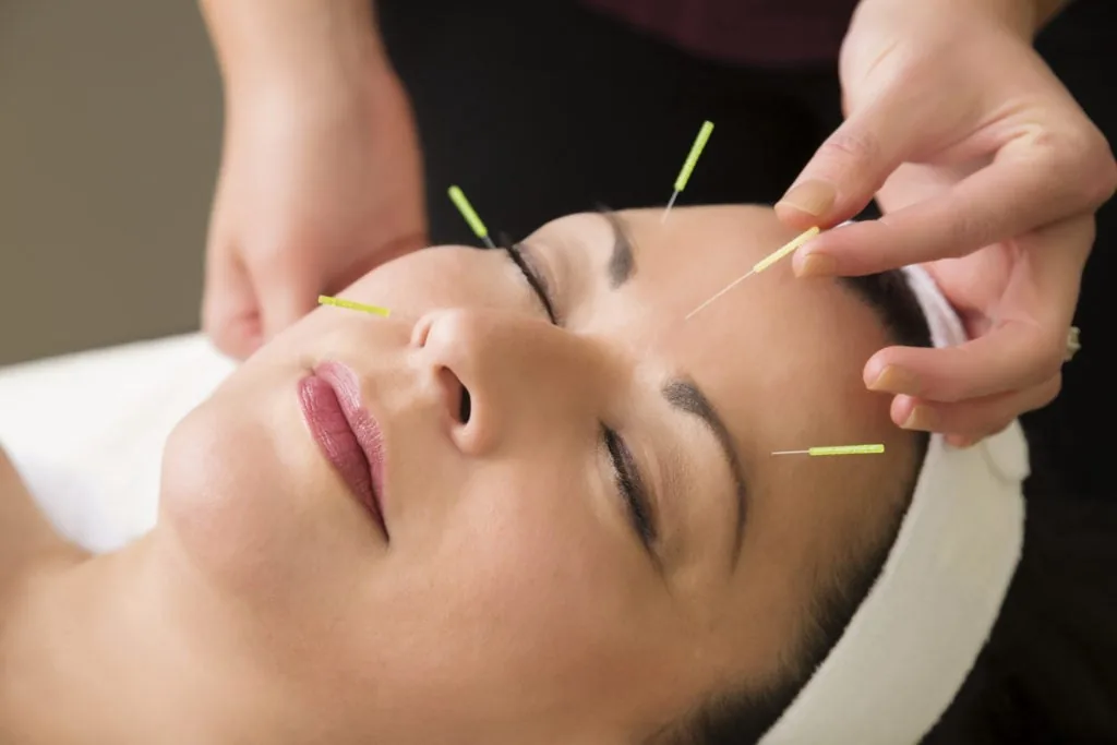 A patient resting calmly during an acupuncture session for stress relief