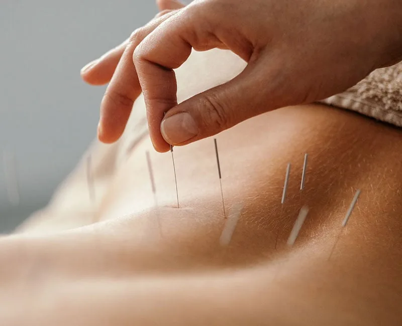 Fine acupuncture needles being placed along a patient's lower back during a treatment session