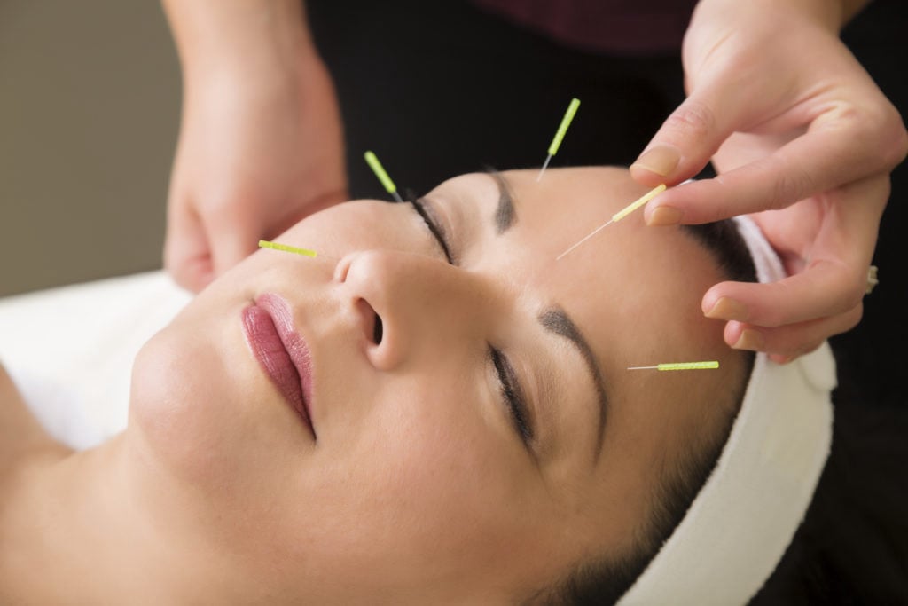 Acupuncture face